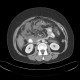 Acute pancreatitis: CT - Computed tomography